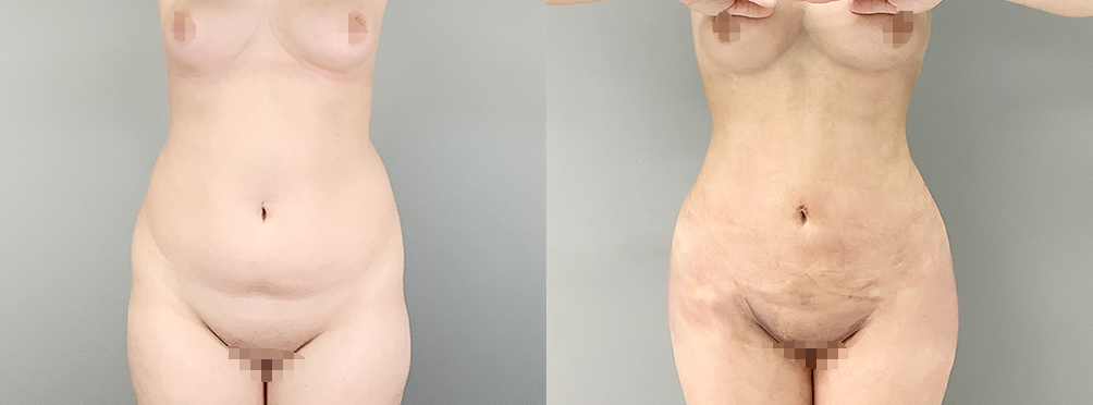 Liposuction Before and After in Miami