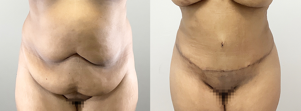 Tummy Tuck Before and After in Miami
