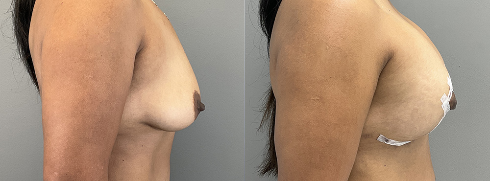 Breast Liff Before and After in Miami