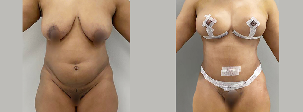 Mommy Makeover Before and After in Miami