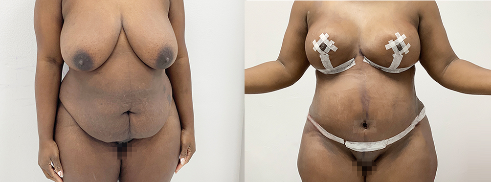 Mommy Makeover Before and After in Miami