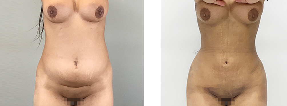 Liposuction Before and After in Miami
