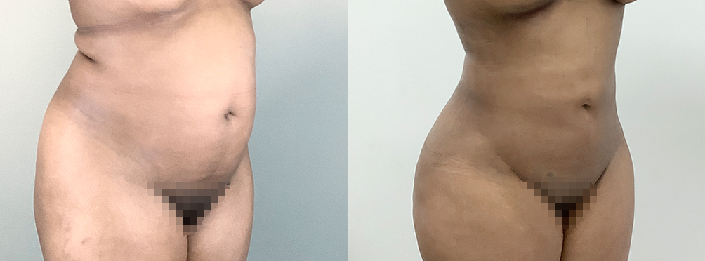 Liposuction Before and After in Miami