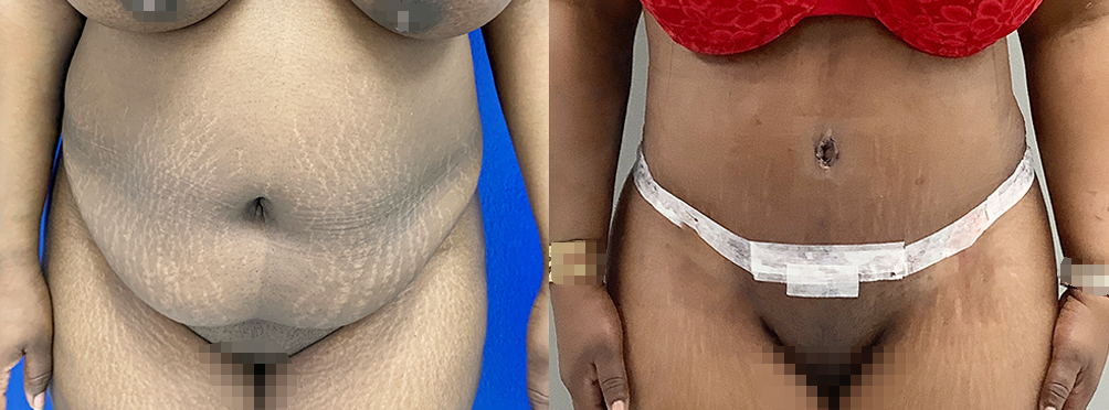 Tummy Tuck Before and After