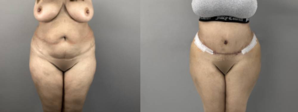 Tummy Tuck Before and After in Miami