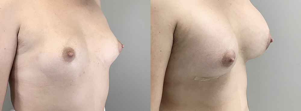 Breast Augmentation Before and After in Miami