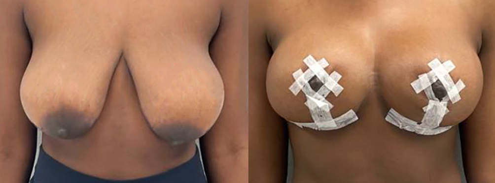 Breast Lift Before and After in Miami