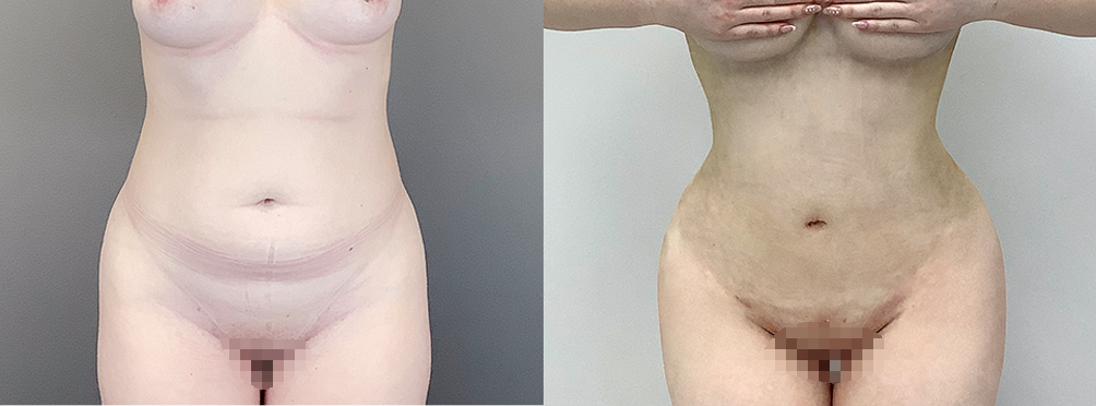 Liposuction Before and After in Miami