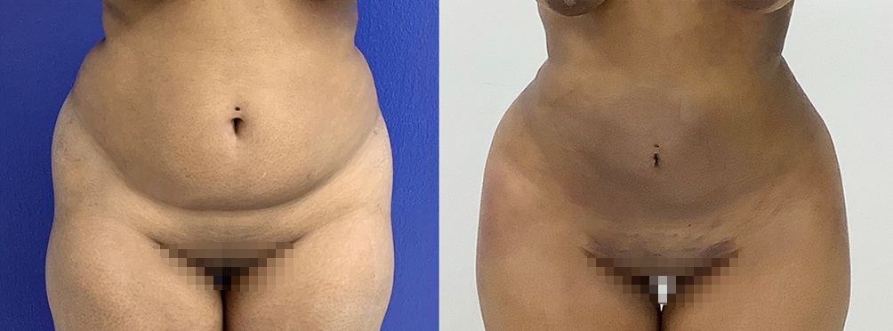 Liposuction Before and After in Miami