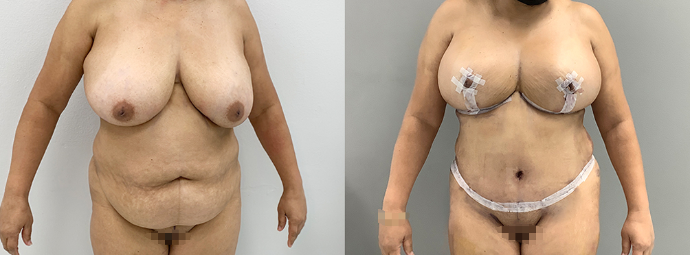 Mommy Makeover Before and After in Miami