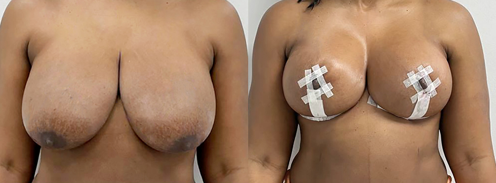 Breast Lift Before and After in Miami