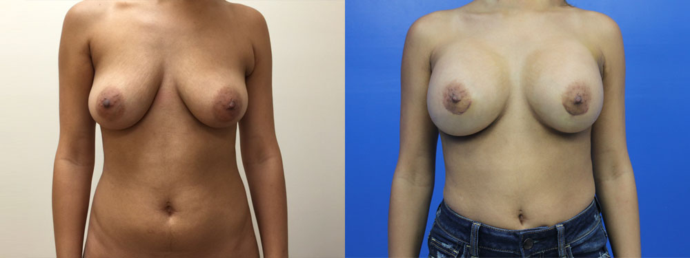 Breast Augmentation Before and After in Miami
