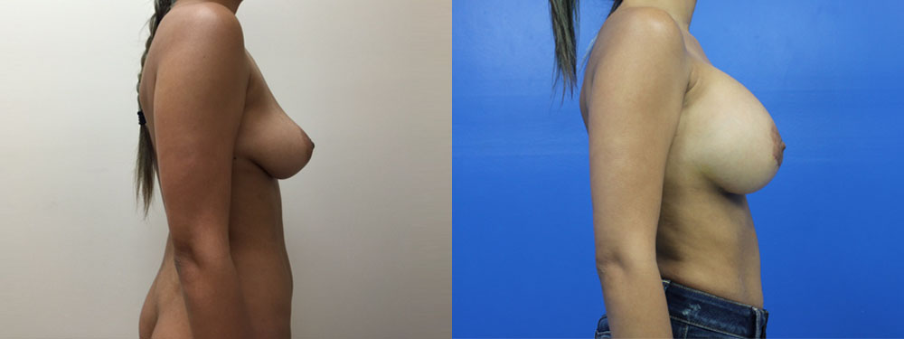 Breast Augmentation Before and After in Miami