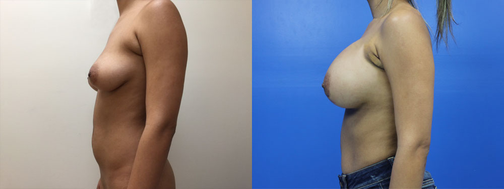 Breast Augmentation Before and After in Miami