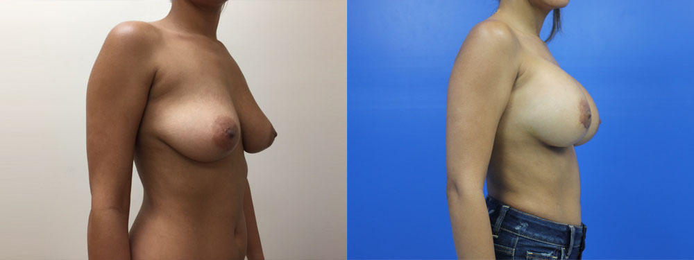 Breast Augmentation Before and After in Miami