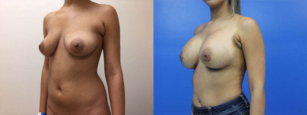 Breast Augmentation Before and After in Miami