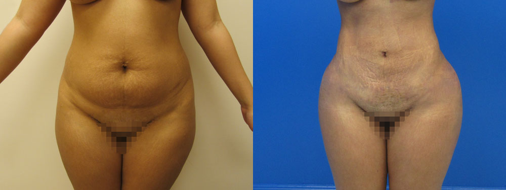 Liposuction Before and After in Miami