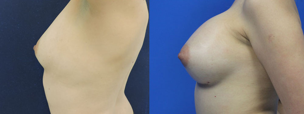 Breast Augmentation Before and After in Miami