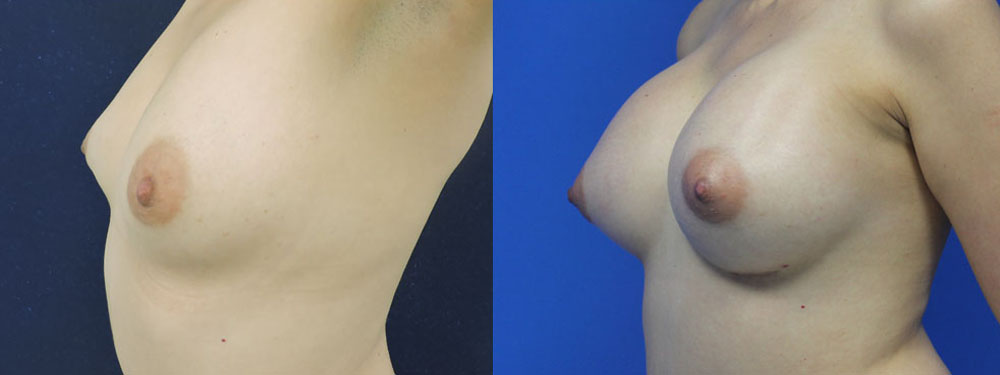Breast Augmentation Before and After in Miami