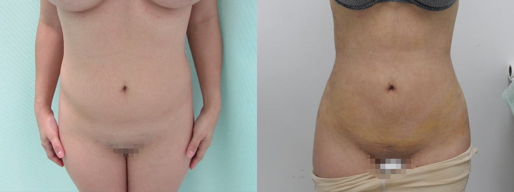 Liposuction Before and After in Miami
