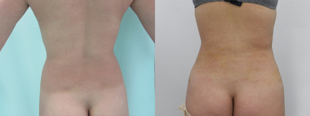 Liposuction Before and After in Miami