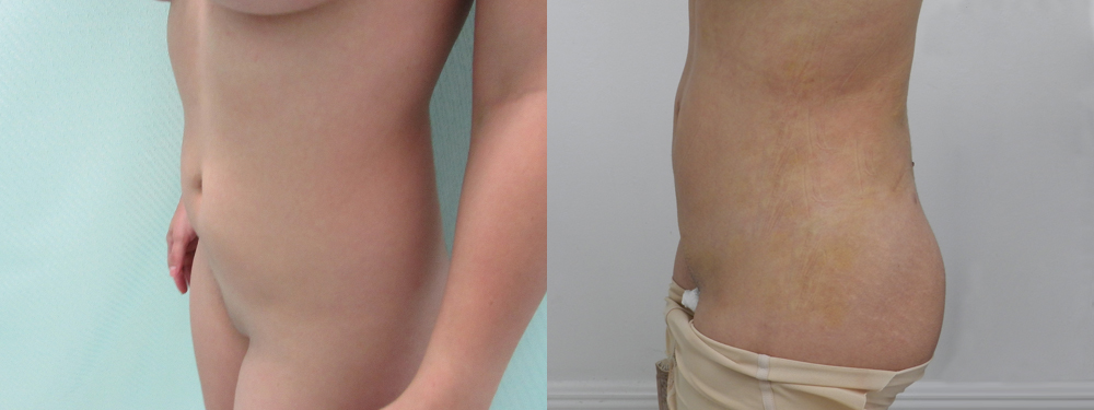 Liposuction Before and After in Miami