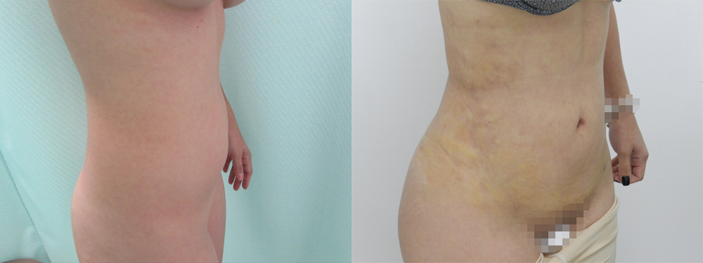 Liposuction Before and After in Miami