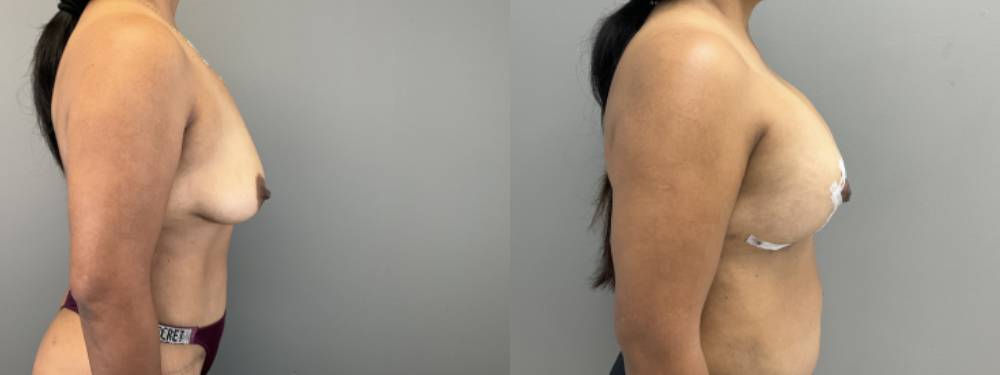 Breast Augmentation Before and After in Miami