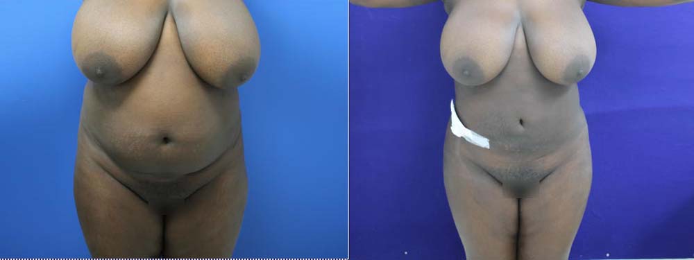 Liposuction Before and After in Miami