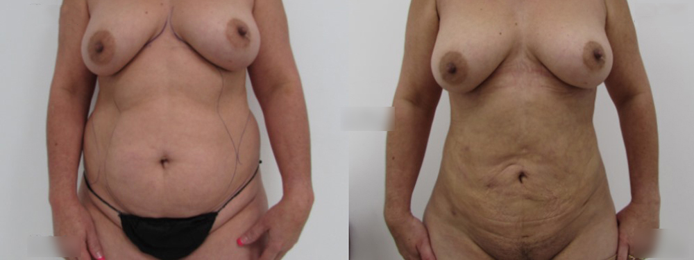 Liposuction Before and After in Miami