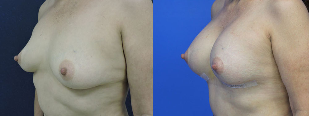 Breast Augmetation Before and After