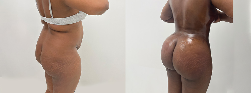 Brazilian Butt Lift Before After photos