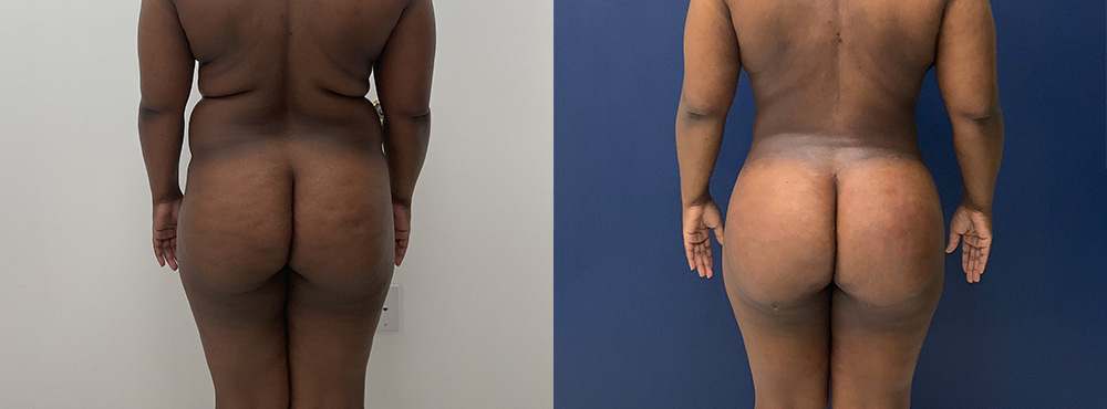 BBL Before and after