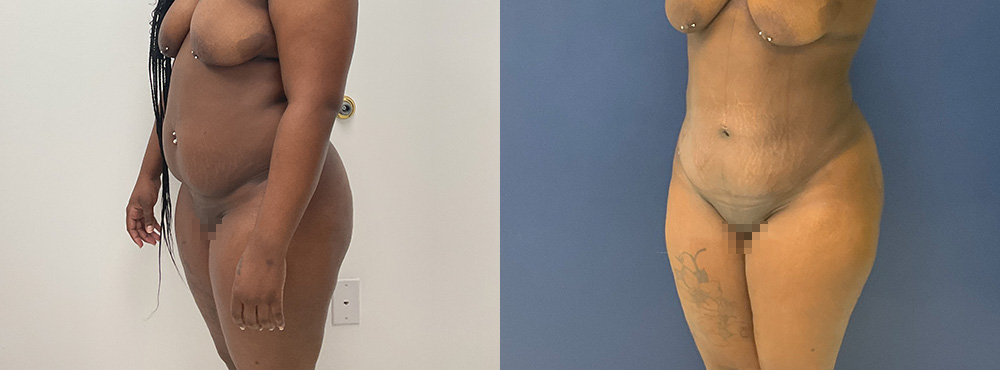 BBL Before and after