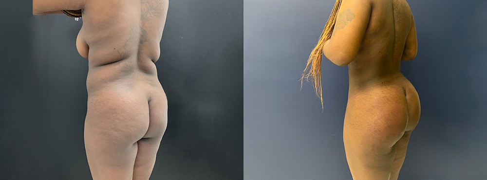 BBL before and after