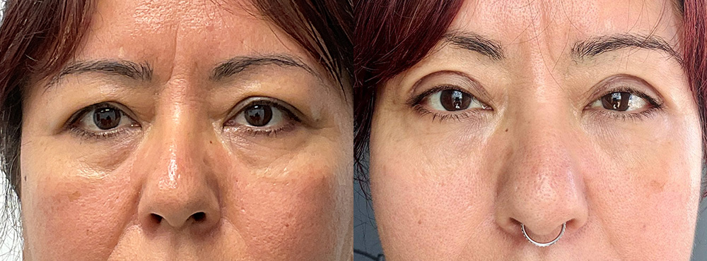 Eyelid surgery before after photo