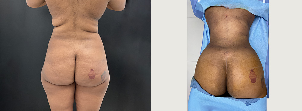 Lipo 360 BBL Before After