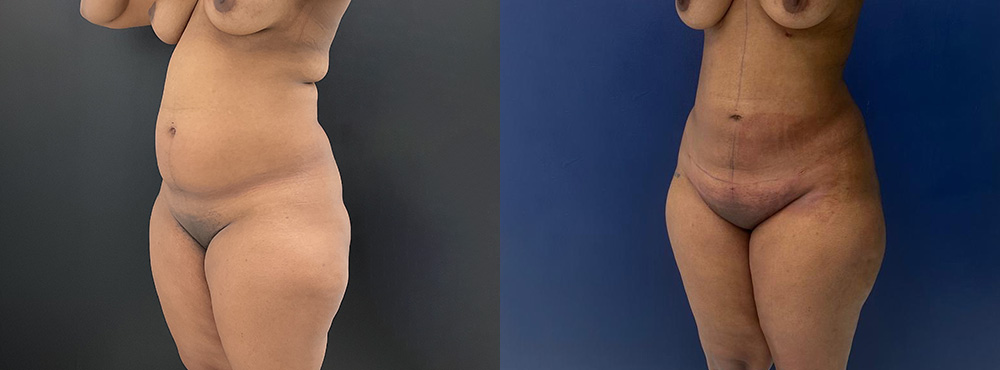 Lipo 360 BBL Before After