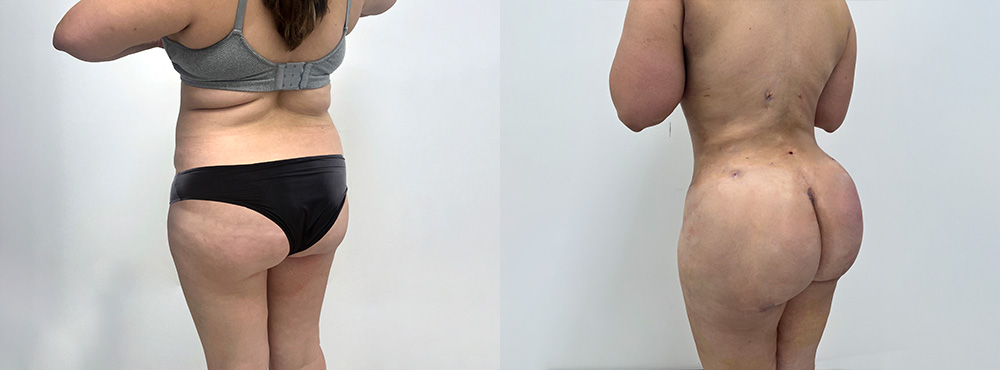 BBL before After Photos