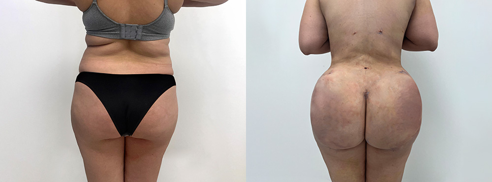 BBL before After Photos