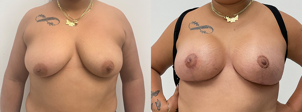 Breast Lift Before After Photos