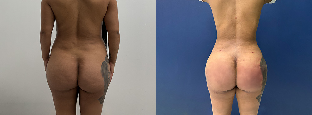 Lipo 360 BBL before and after photos