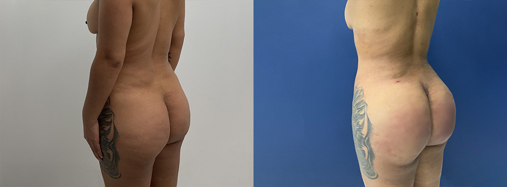 Lipo 360 BBL before and after photos