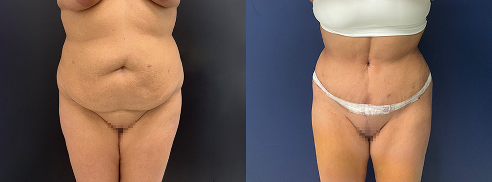 Tummy Tuck Before After Photos