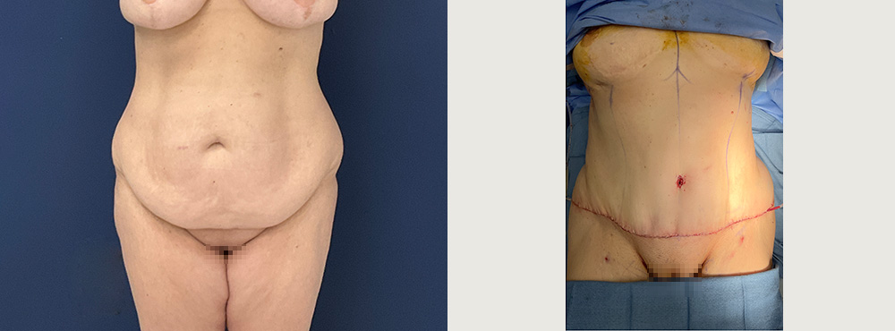 Tummy Tuck Before and After