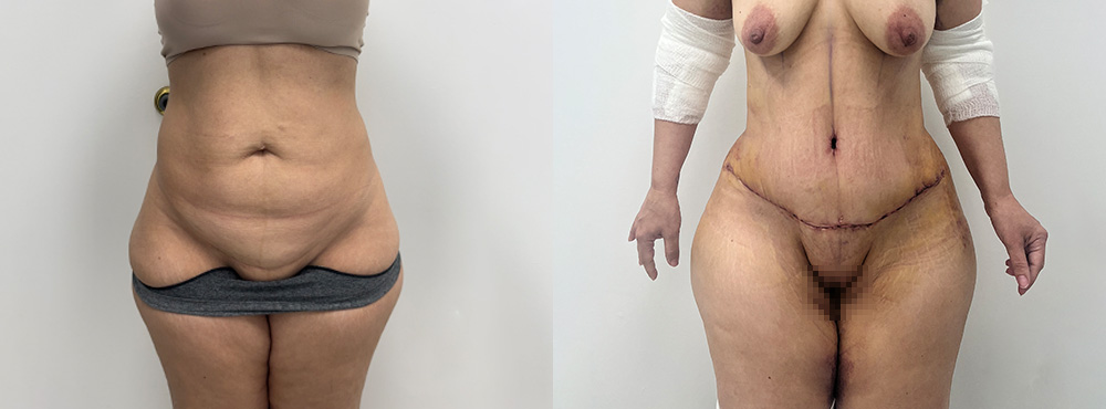 Tummy Tuck before After photos