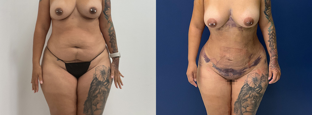 Tummy Tuck Before and After