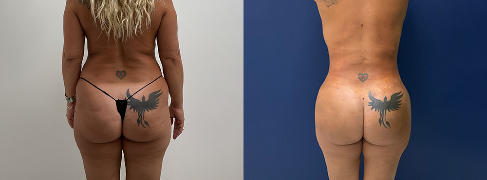 Brazilian Butt Lift before After