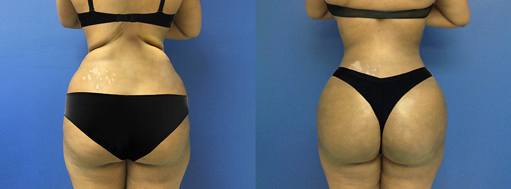 Brazilian Butt Lift Before and After