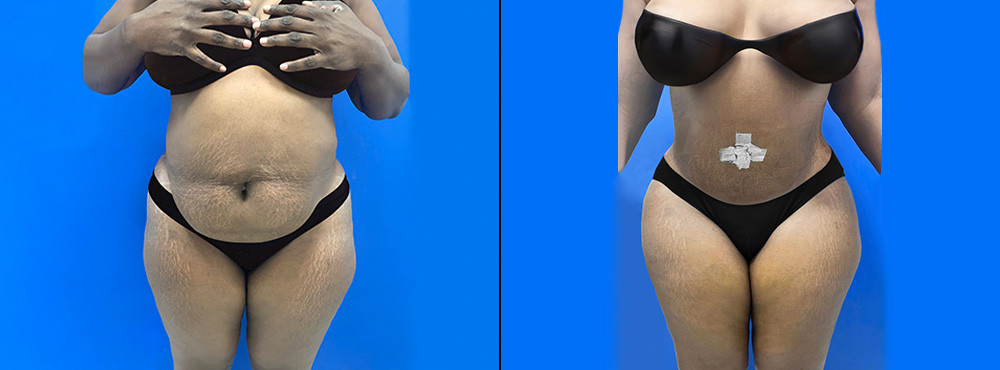Tummy Tuck Before and After